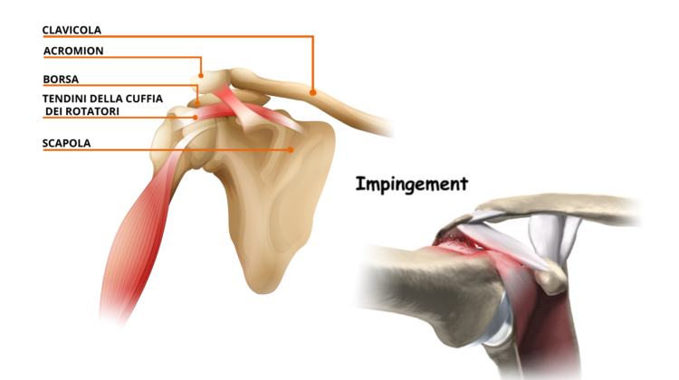 IMPINGEMENT