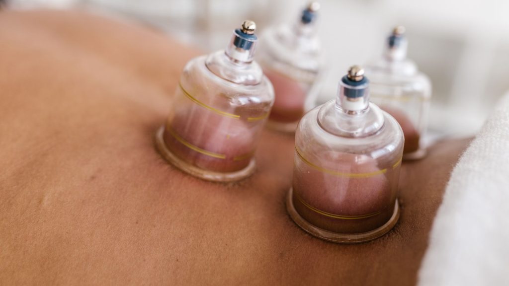 Cupping Therapy